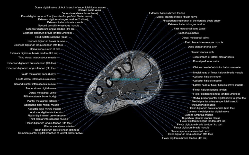 MRI mid foot axial cross sectional anatomy 3T radiology image