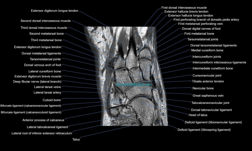 MRI mid foot coronal cross sectional anatomy 3T radiology image