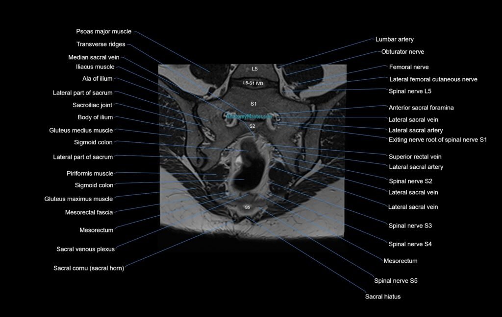 MRI sacroiliac joint coronal cross sectional anatomy radiology image