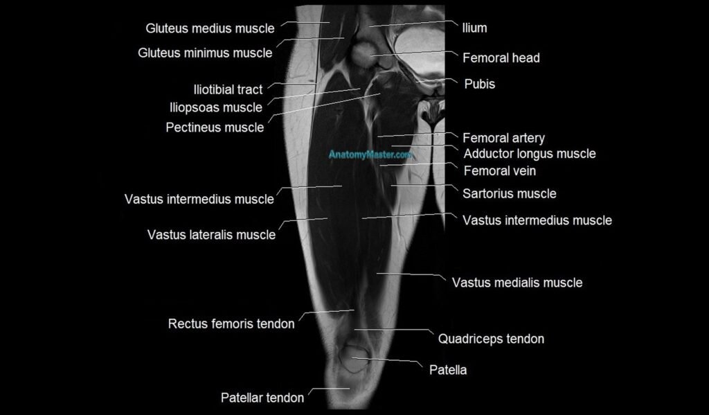 MRI thigh coronal cross sectional anatomy image
