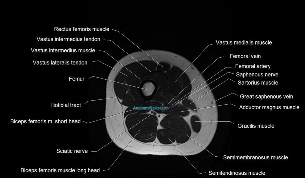 MRI thigh cross sectional anatomy image