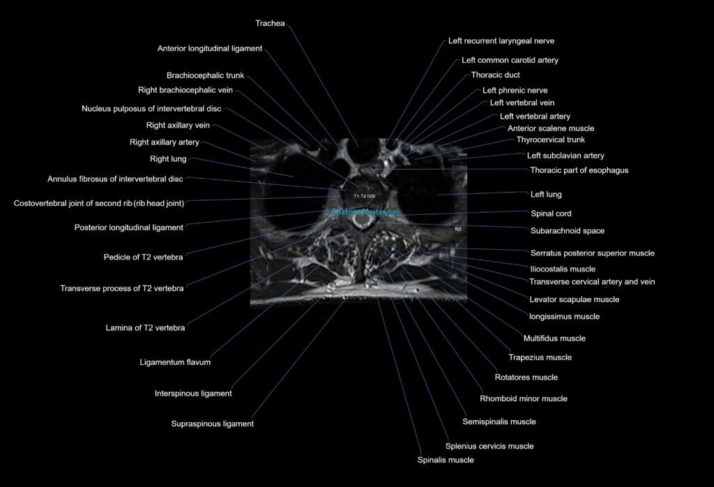 MRI thoracic spine axial cross sectional anatomy 3T radiology image