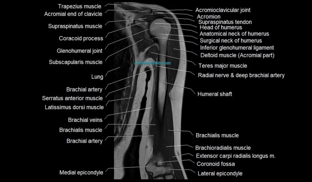 MRI upper arm (humerus ) coronal cross sectional anatomy image