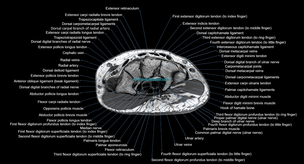 MRI wrist axial cross sectional anatomy 3T radiology image