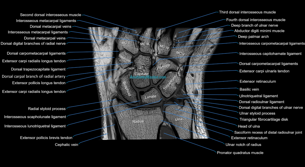 MRI wrist coronal cross sectional anatomy 3T radiology image