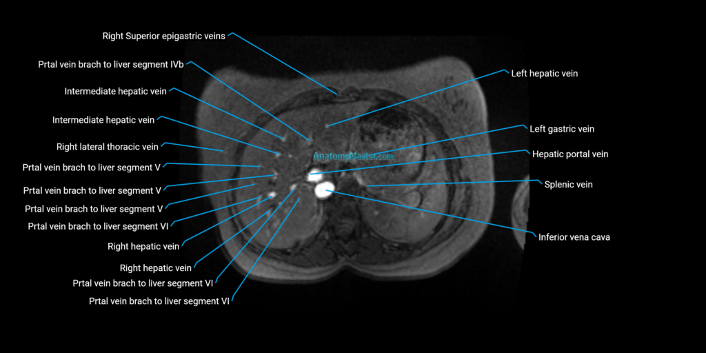 MRV Abdomen, Pelvis and Lower Limb Anatomy image