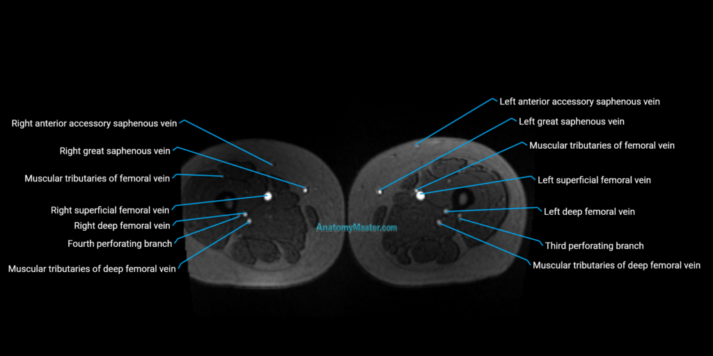 MRV Abdomen, Pelvis and Lower Limb Anatomy image 3