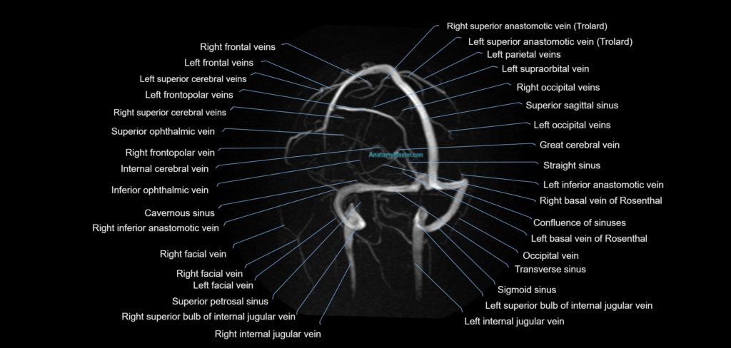 MRV brain MIP sagittal labelled anatomy 3T MRI images