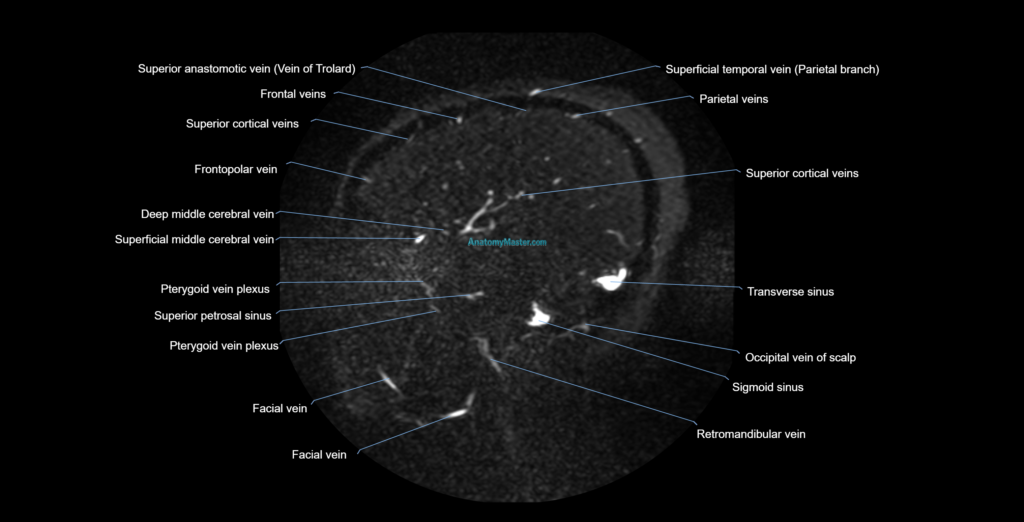 MRV brain sagittal anatomy 3T MRI images