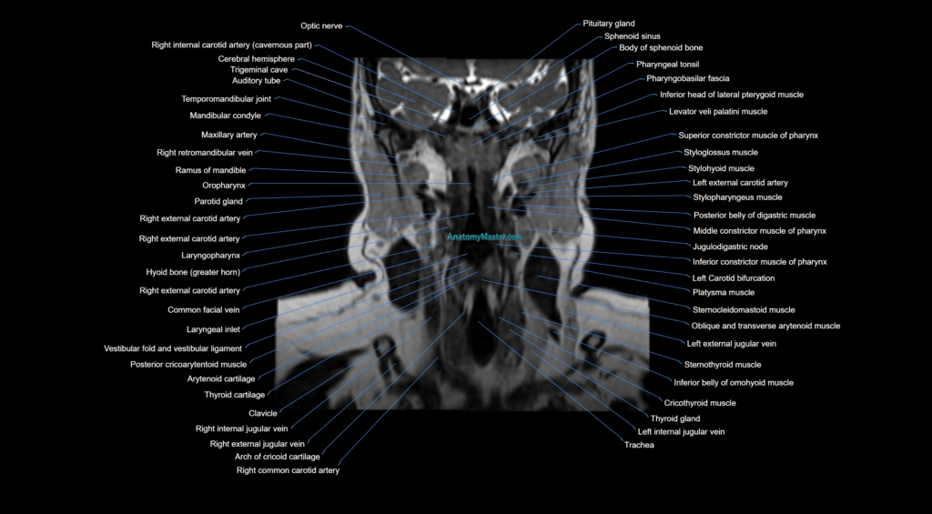 Neck coronal cross sectional MRI anatomy 3T MRI image