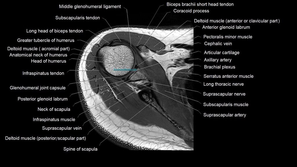 Shoulder cross sectional anatomy MRI 3T axial image