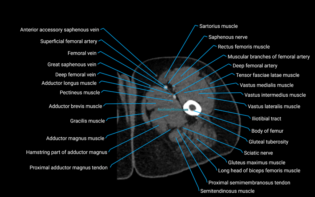 CT lower limb axial cross sectional anatomy labelled image 2