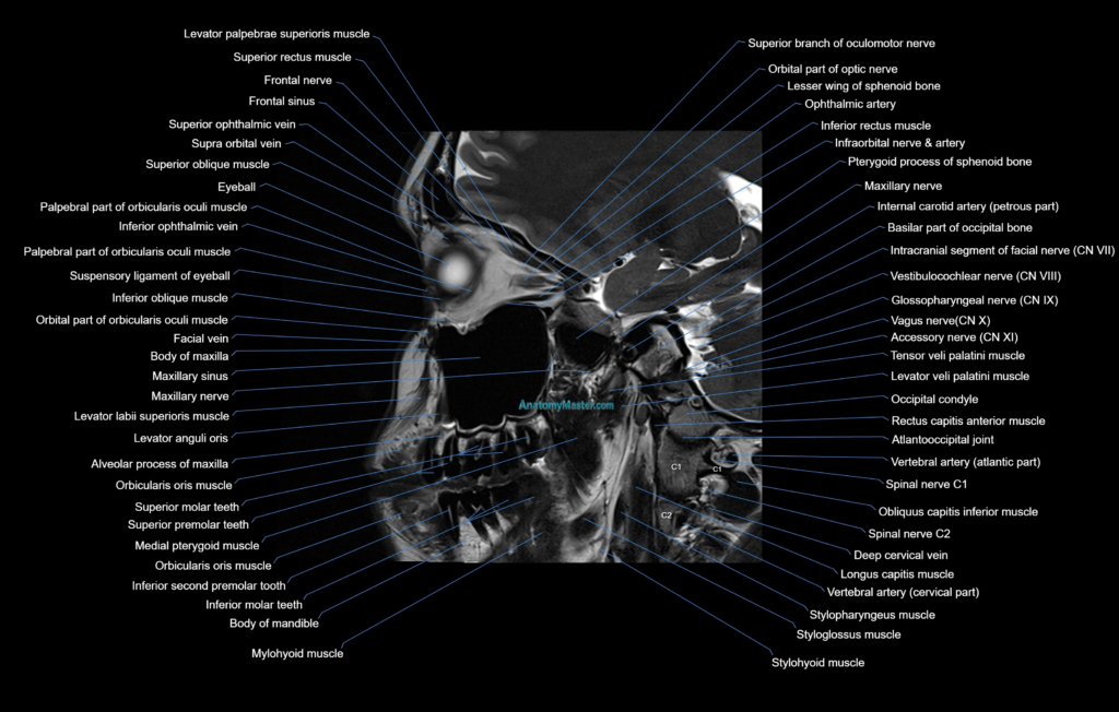 paranasal sinuses(PNS) MRI coronal cross sectional anatomy 3T radiology image