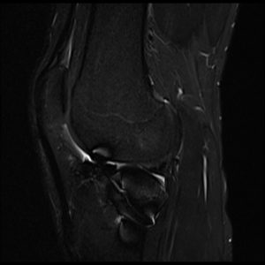 MARS MRI | metal artifact reduction mri