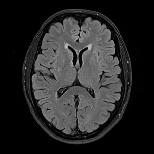 TI MRI | MRI Inversion Time (TI)
