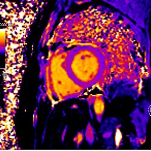 cardiac MRI native T1 mapping