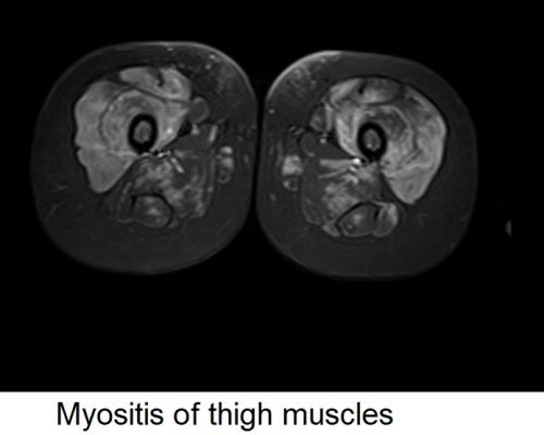 myositis of thigh muscles
