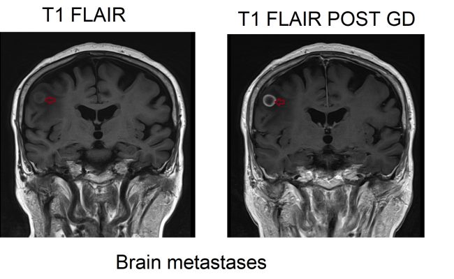 t1 flair pre and post contrast 3t image brain metastases